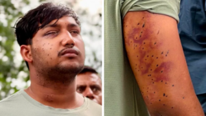 Experts Say Delhi Protesters Show Pellet Gun Wound Patterns