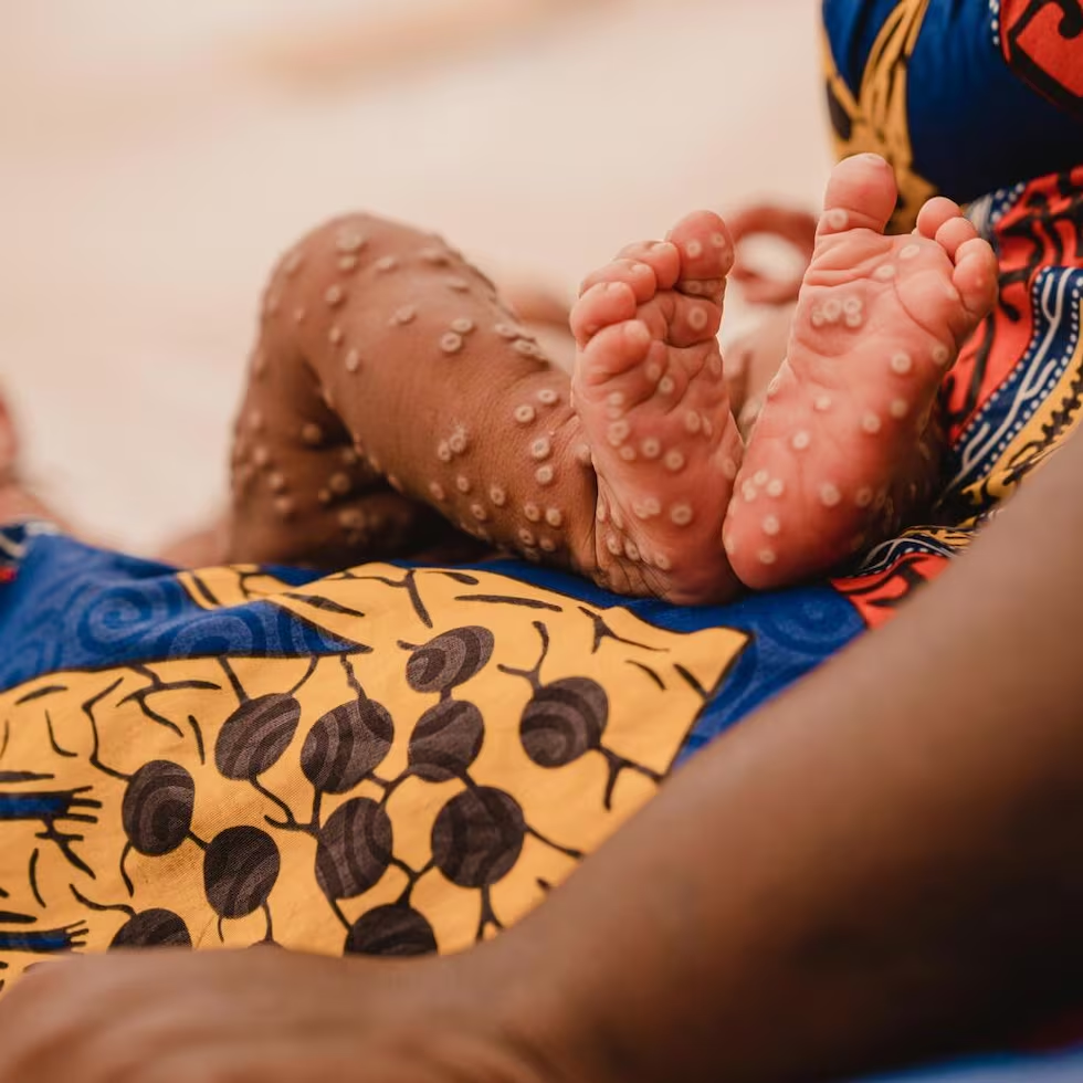 Global Initiative Launched to Boost Access to Mpox Vaccines